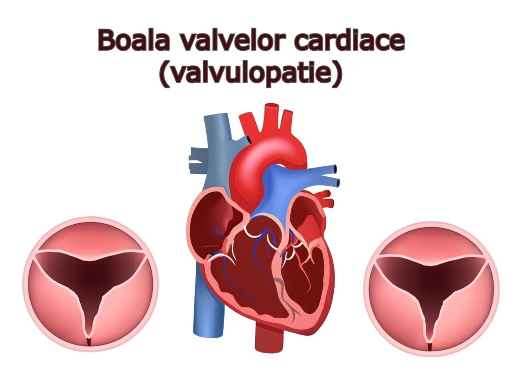 Totul despre boala valvelor cardiace(valvulopatie) : simptome, cauze și tratament