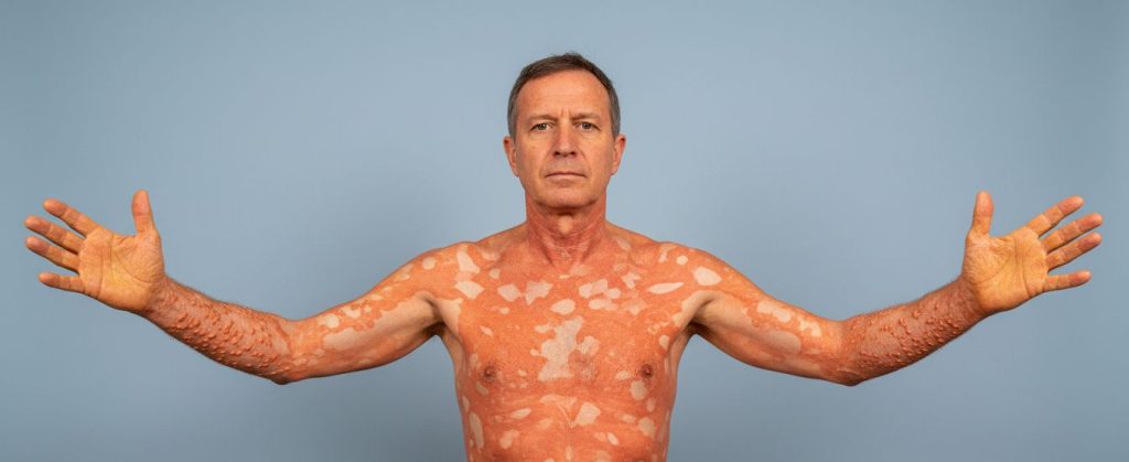 Pityriasis rubra pilaris